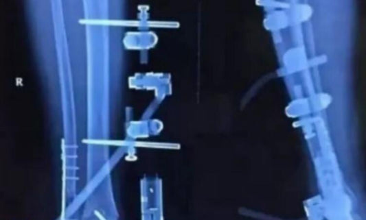 Carbon fiber for artificial bones and artificial joints
